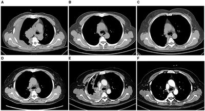 Case report: Emerging therapies for transformed small cell lung cancer: efficacy of serplulimab and a comprehensive case report